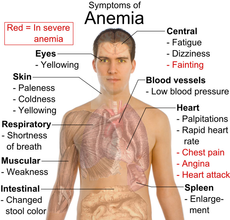 Iron-deficiency-anemia2